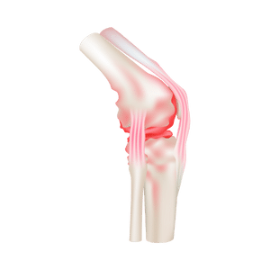 Understanding Knee Arthritis - Dr. Abhishek Chaturvedi, Orthopedic surgeon in Mira Road and Malad