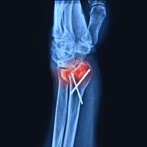 Bone Fracture - Symptom of Osteoporosis