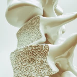 Osteoporosis - Orthopedic Problem