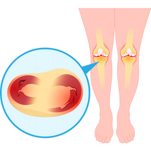 Patellofemoral Pain Syndrome