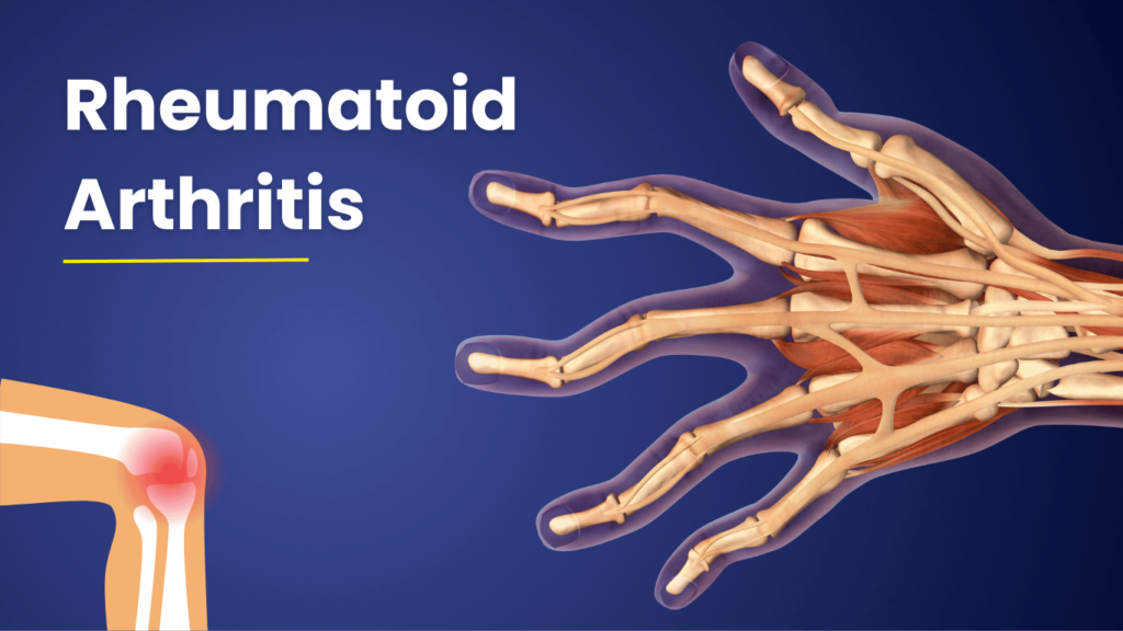 What is Rheumatoid Arthritis?