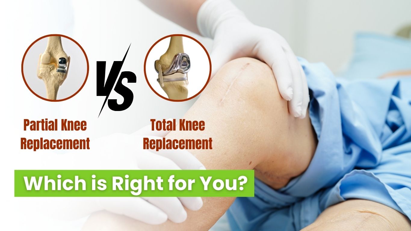 Partial and Total Knee Replacement Surgery | Dr. Abhishek Chaturvedi