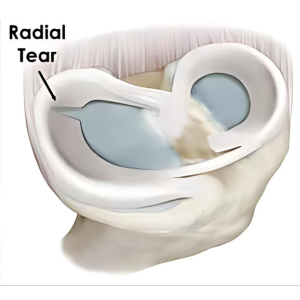 Radial Meniscus Tear : Orthopedic Surgeon in Malad