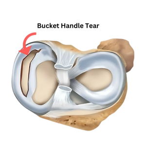 Bucket Handle Meniscus Tear : Orthopedic Surgeon in Malad