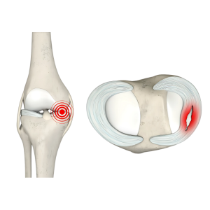 Meniscus Tear - Orthopedic Surgeon in Malad