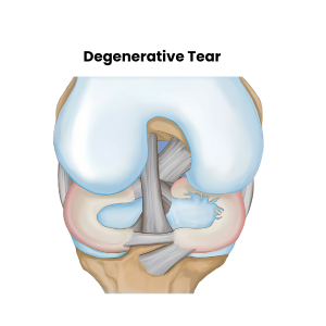 Degenerative Meniscus Tear