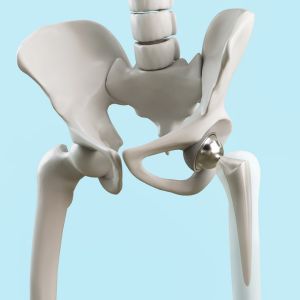 Hip Replacement Surgery