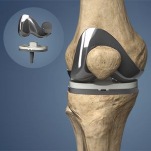 Knee Replacement Surgery