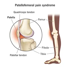 Patellofemoral Pain Syndrome 